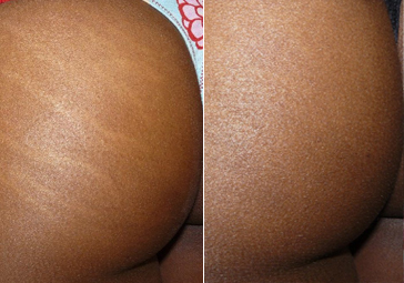 carboxytherapy for stretch marks