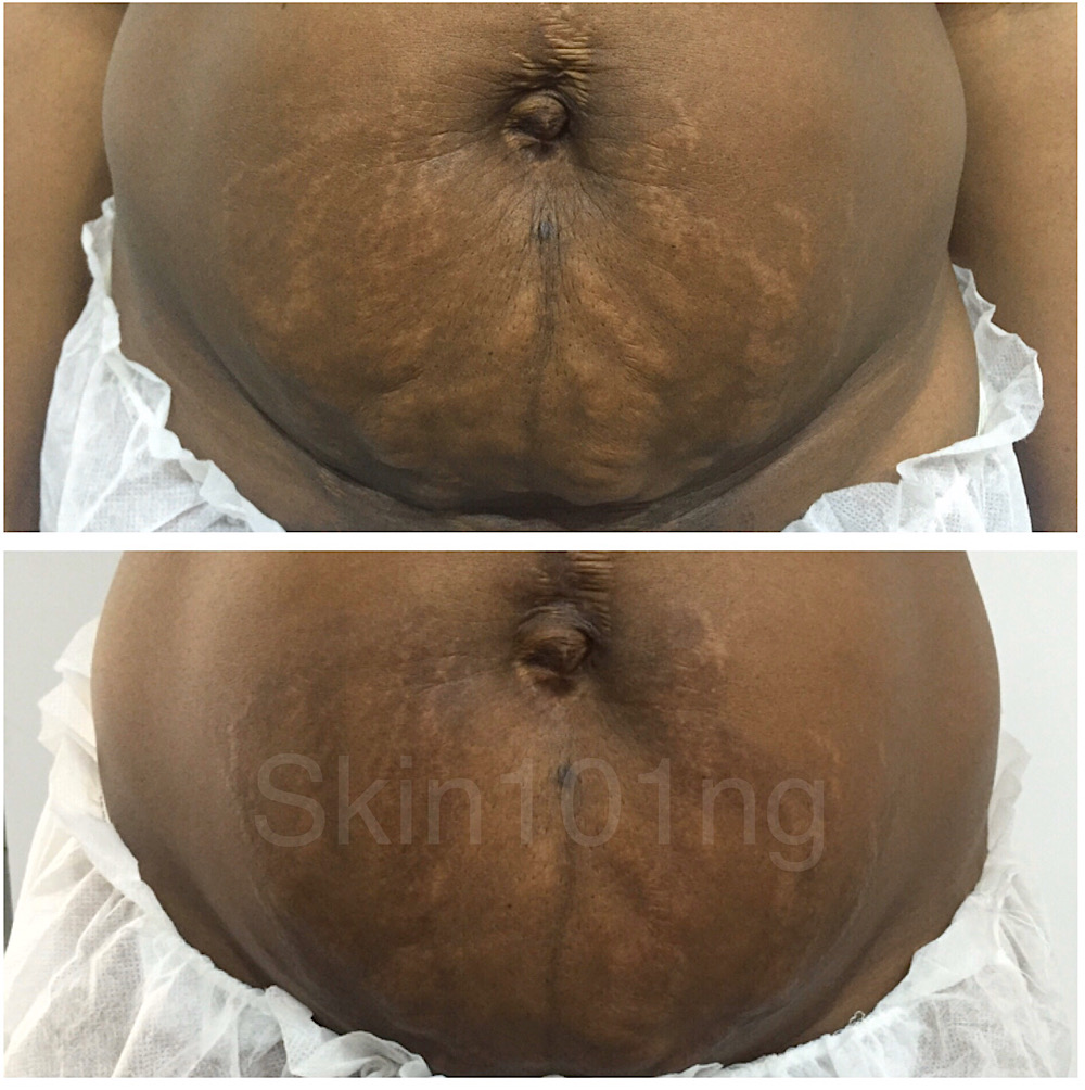 Stretch mark treatment before and after