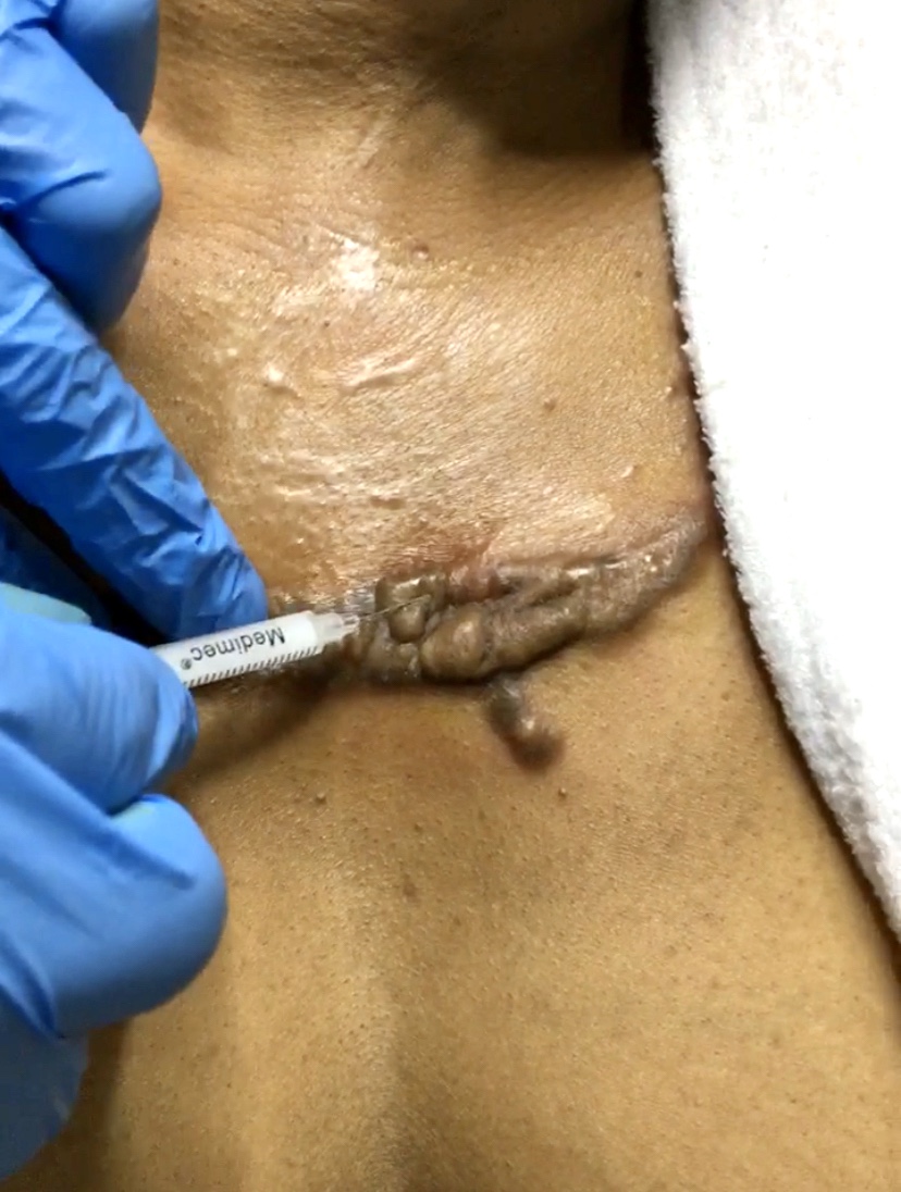 Intralesional steroid injection keloid treatment in nigeria