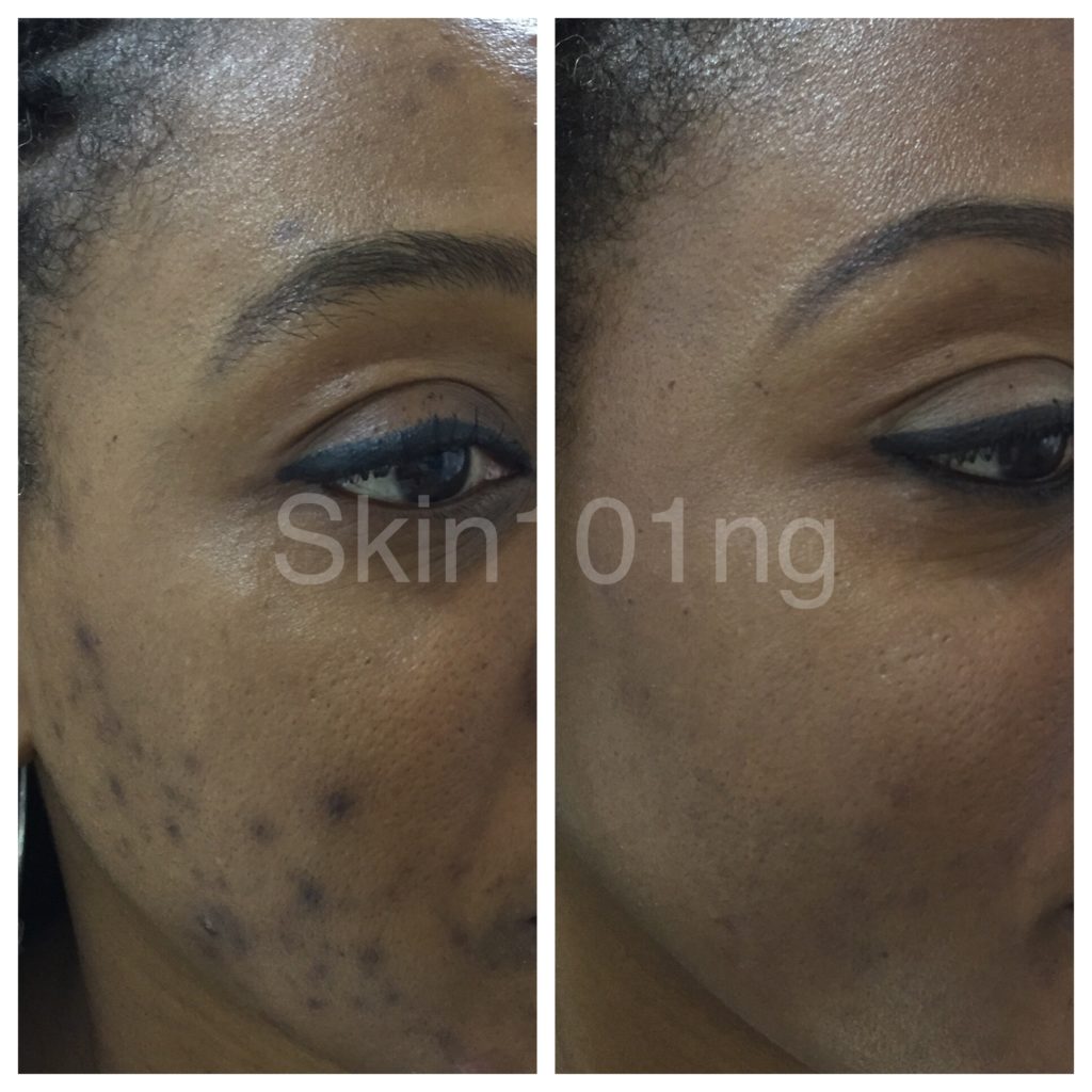 PIH Before and After Hyperpigmentation Treatment