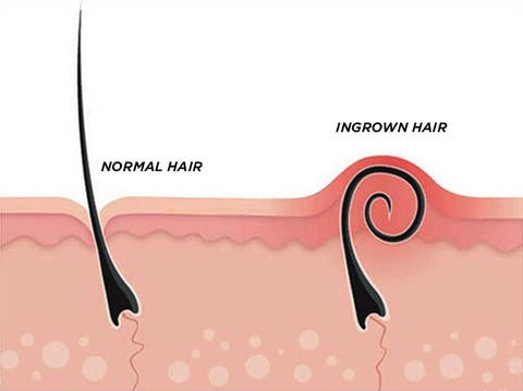ingrown hair