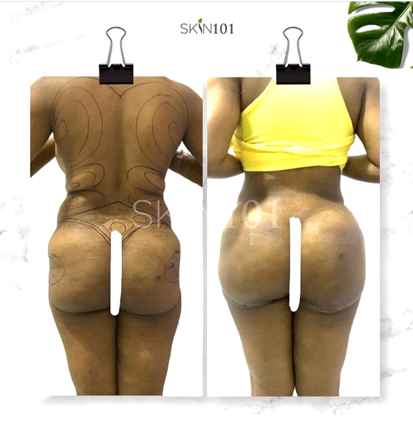liposuction with fat transfer before and after back view