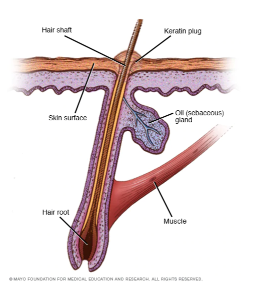 How Keratosis pilaris occurs