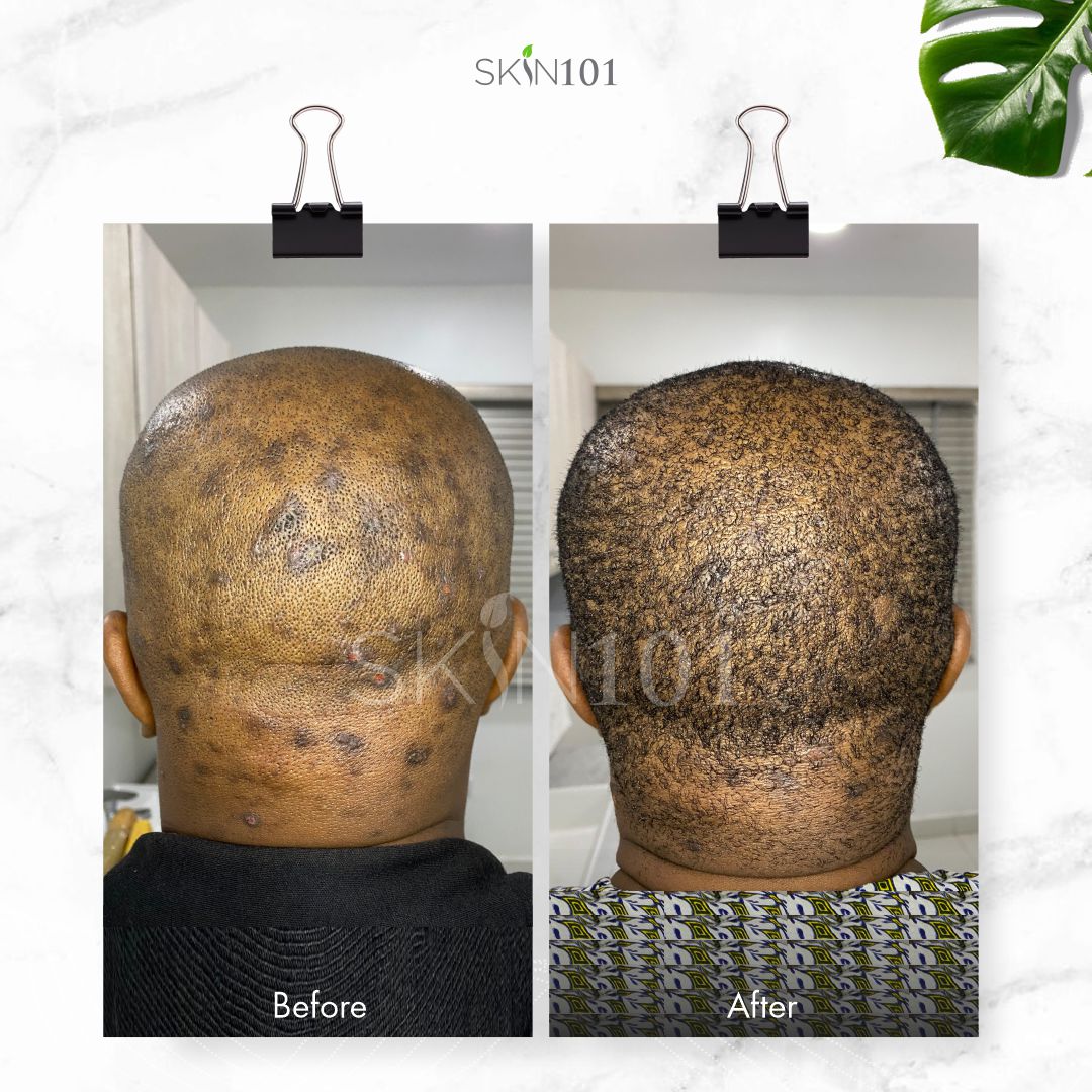 Scalp Folliculitis Before And After