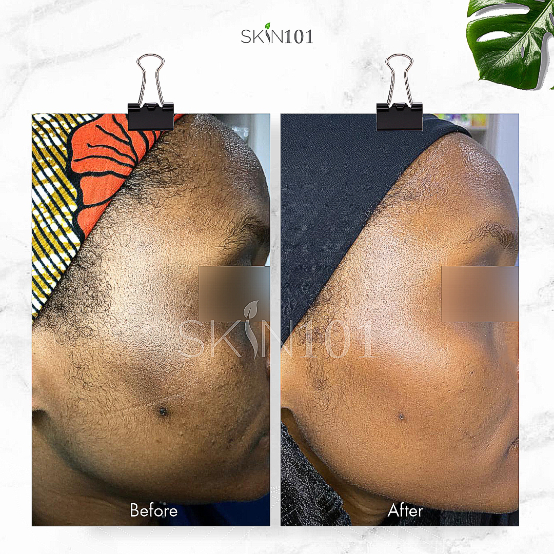 Hyperpigmentation treatment before and after