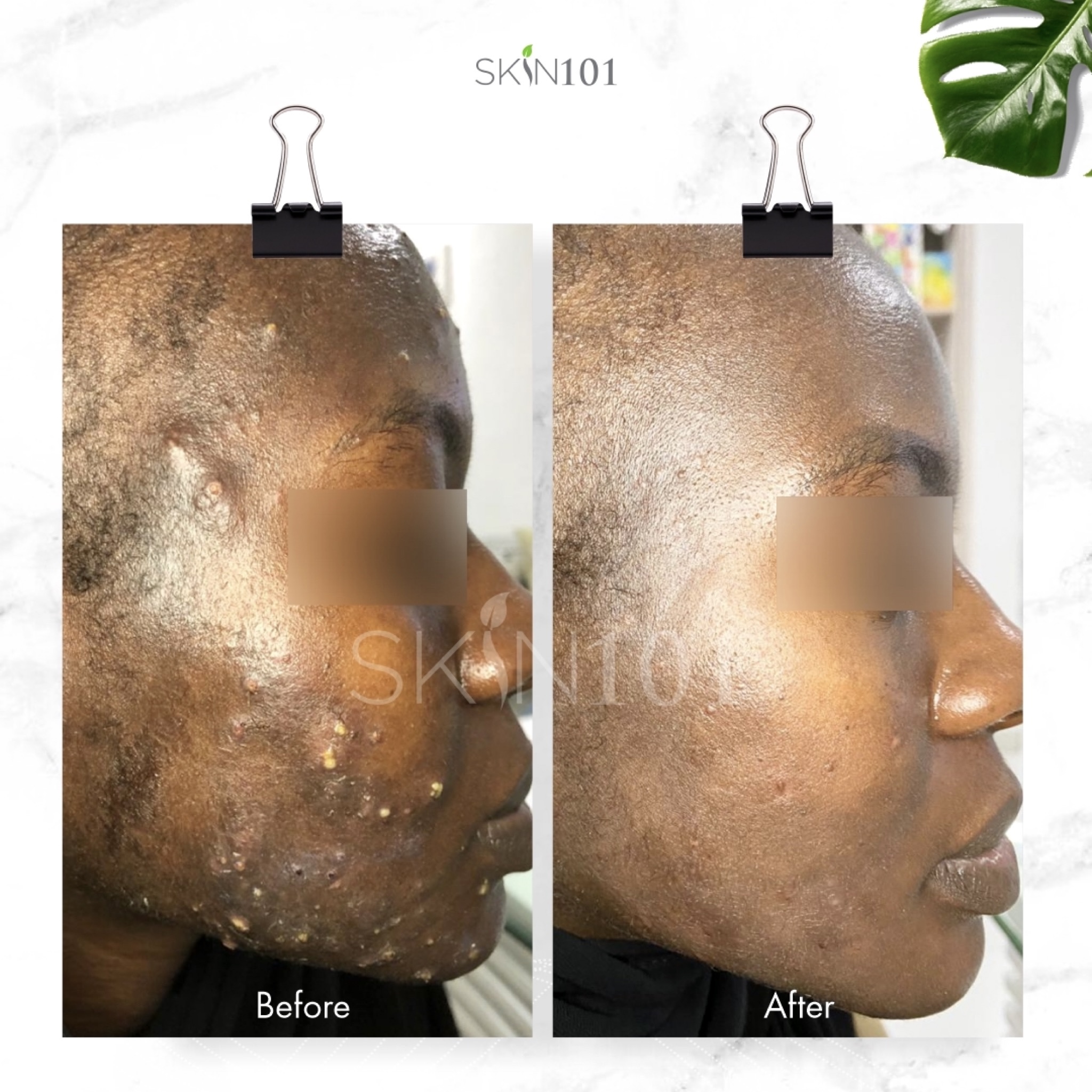 Severe Acne Treatment Before and After