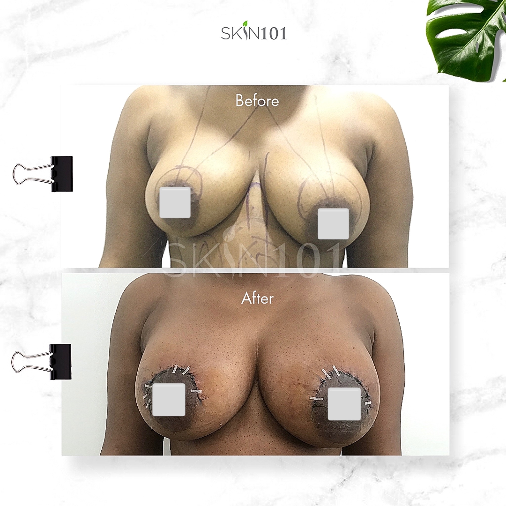 Where to do Breast augmentation with implants in Abuja Nigeria