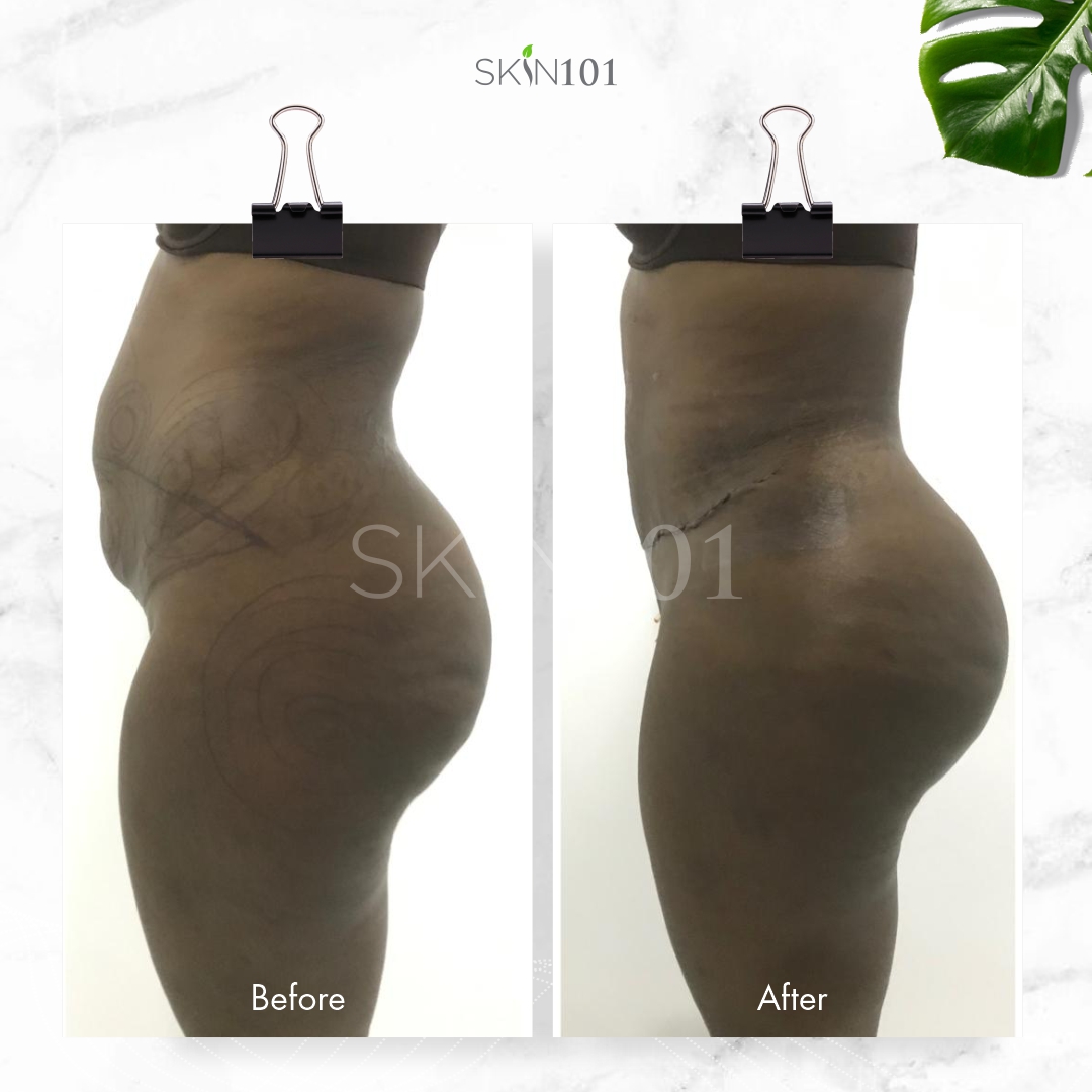 Tummy Tuck Before and after Abuja Nigeria