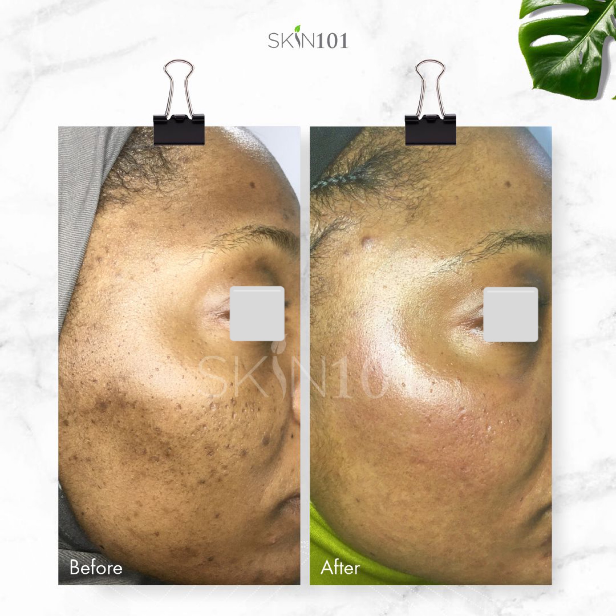 Post Inflammatory Hyperpigmentation PIH From Acne - Before And After