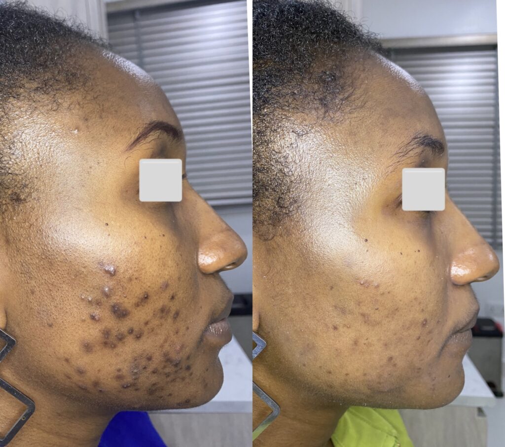 Newmelan peel for hyperpigmentation before and after