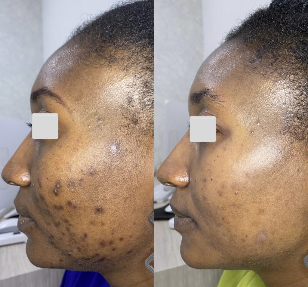 Newmelan peel for hyperpigmentation before and after