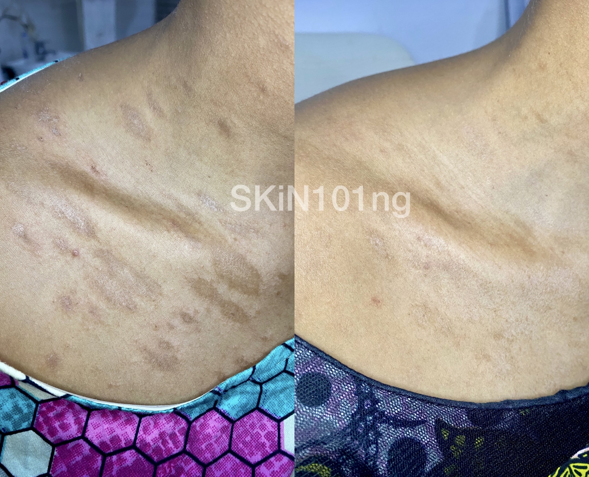 Pityriasis Rosea Before and After Two weeks of treatment