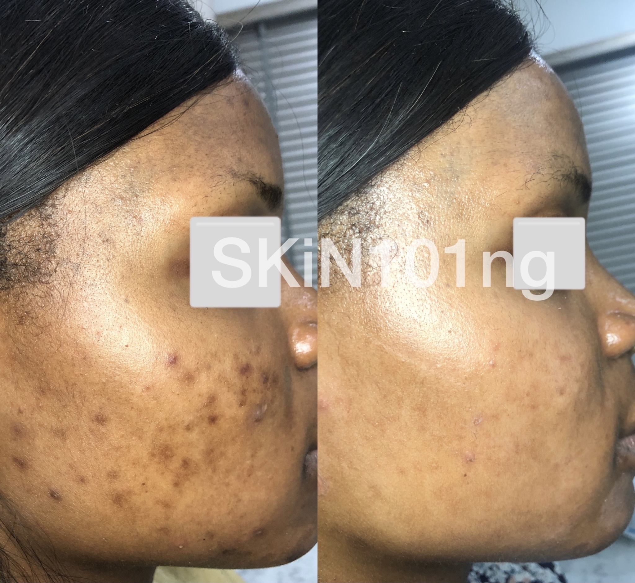 treatment of PIH from acne before and after abuja nigeria skin clinic